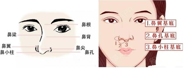 隆鼻后鼻梁的八字印