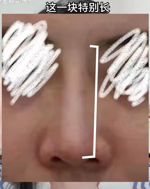 隆鼻后鼻梁的八字印