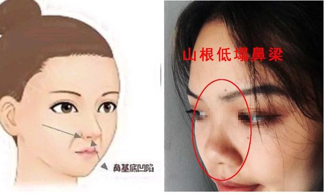 隆鼻后鼻梁的八字印
