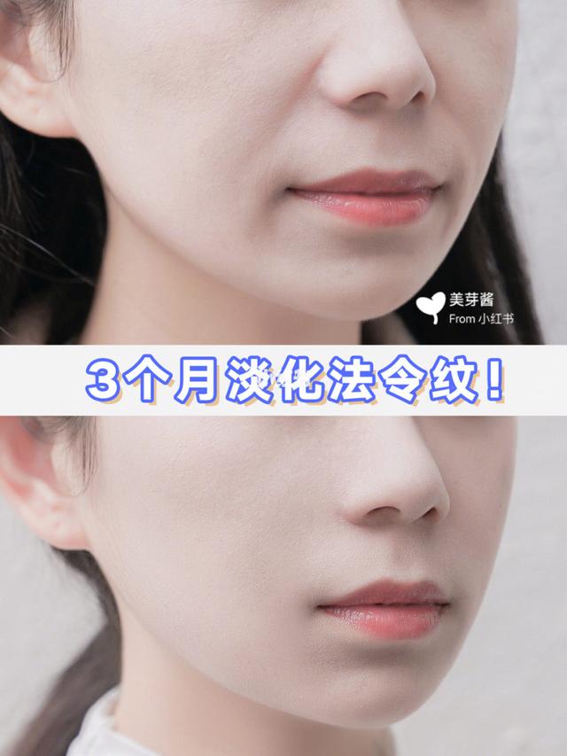 八字纹怎么去掉 八字纹怎么去掉