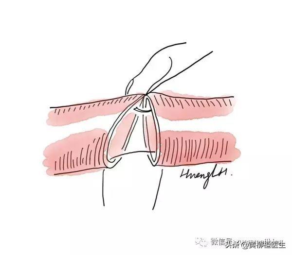 血管八字缝合