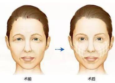 埋线八字填充 埋线八字填充