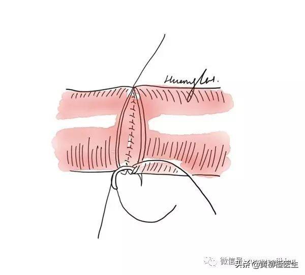 血管八字缝合