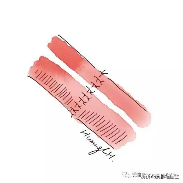 血管八字缝合