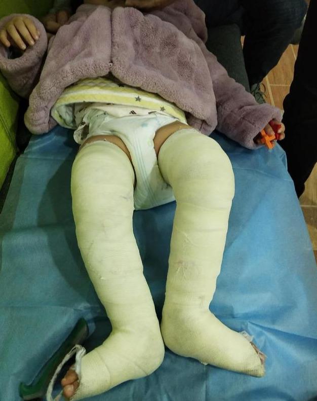 如何纠正幼儿的八字腿 如何纠正幼儿的八字腿