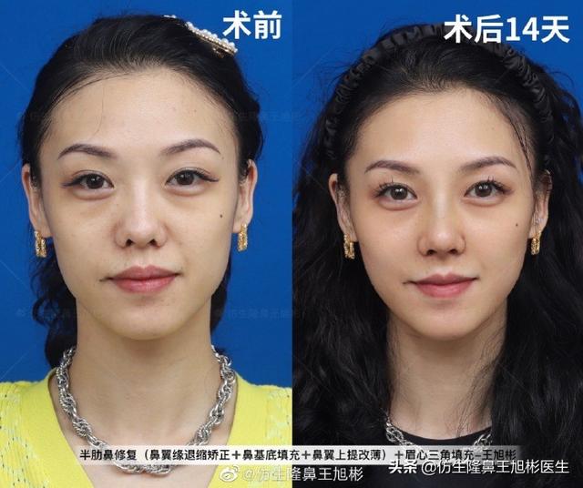 垫鼻子可以去八字纹吗 垫鼻子可以去八字纹吗