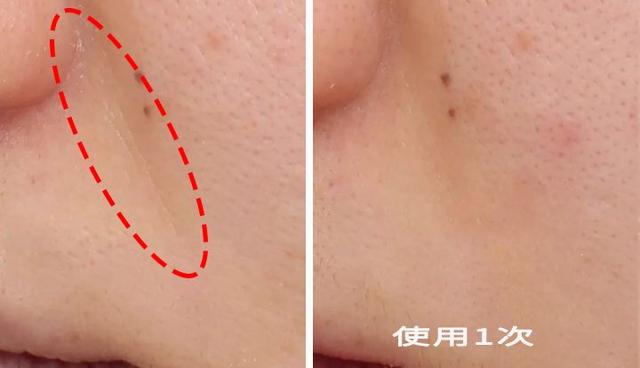 如何消除额头八字纹 如何消除额头八字纹