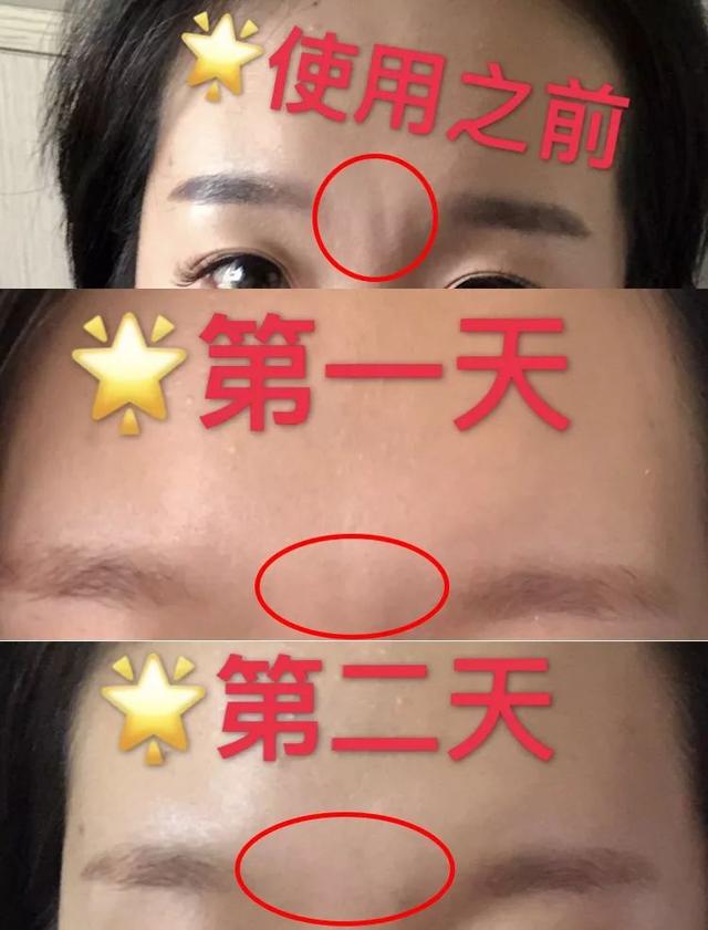 如何消除额头八字纹 如何消除额头八字纹