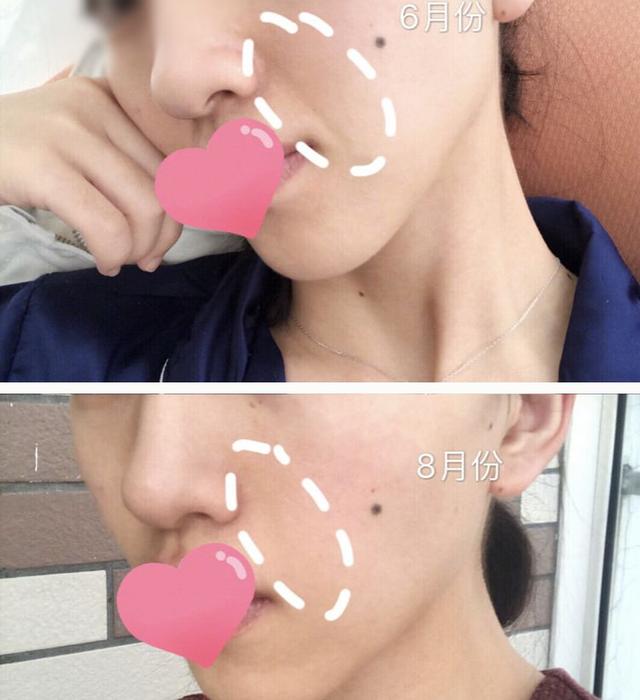 如何消除额头八字纹 如何消除额头八字纹