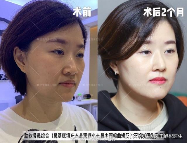 垫鼻子可以去八字纹吗 垫鼻子可以去八字纹吗