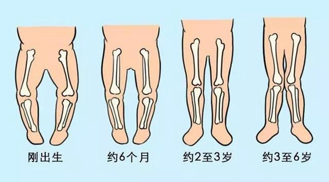 不要看到宝宝八字腿就认为不正常 不要看到宝宝八字腿就认为不正常