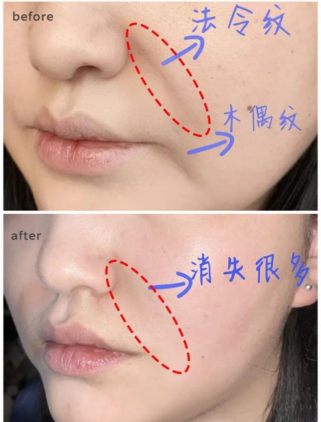 如何消除额头八字纹 如何消除额头八字纹