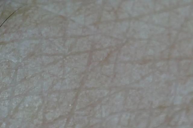 如何消除额头八字纹 如何消除额头八字纹
