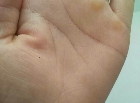 女人左手掌有痣好不好