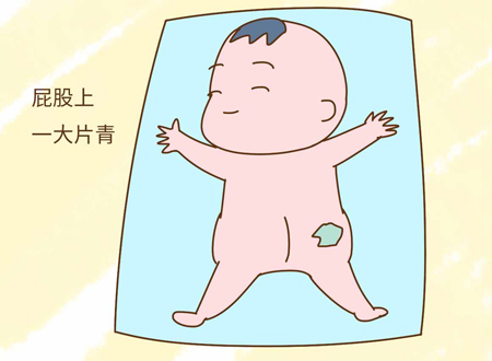 屁股胎记寓意着什么